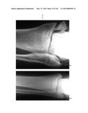 INTRAMEDULLARY FRACTURE FIXATION DEVICES AND METHODS diagram and image