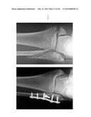 INTRAMEDULLARY FRACTURE FIXATION DEVICES AND METHODS diagram and image