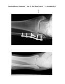 INTRAMEDULLARY FRACTURE FIXATION DEVICES AND METHODS diagram and image