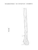 INTRAMEDULLARY FRACTURE FIXATION DEVICES AND METHODS diagram and image