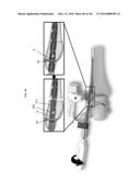 INTRAMEDULLARY FRACTURE FIXATION DEVICES AND METHODS diagram and image