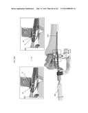 INTRAMEDULLARY FRACTURE FIXATION DEVICES AND METHODS diagram and image