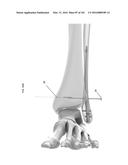 INTRAMEDULLARY FRACTURE FIXATION DEVICES AND METHODS diagram and image