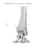 INTRAMEDULLARY FRACTURE FIXATION DEVICES AND METHODS diagram and image