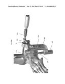 INTRAMEDULLARY FRACTURE FIXATION DEVICES AND METHODS diagram and image