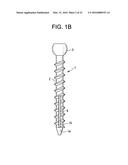 Expansion Screw Bone Tamp diagram and image