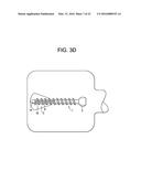 Expansion Screw Bone Tamp diagram and image