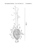 Whale Concept - Folding Mesh for TIPP procedure for Inguinal Hernia diagram and image