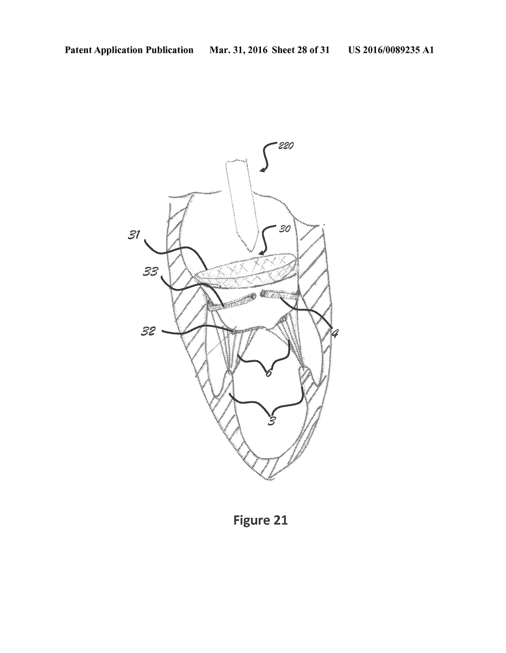 TRANSCATHETER PROSTHETIC VALVE FOR MITRAL OR TRICUSPID VALVE REPLACEMENT - diagram, schematic, and image 29