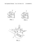 EXPANDABLE INTERBODY FUSION DEVICE diagram and image