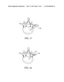 EXPANDABLE INTERBODY FUSION DEVICE diagram and image