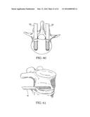 EXPANDABLE INTERBODY FUSION DEVICE diagram and image