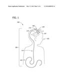 METHOD OF USING A CATHETER ASSEMBLY diagram and image