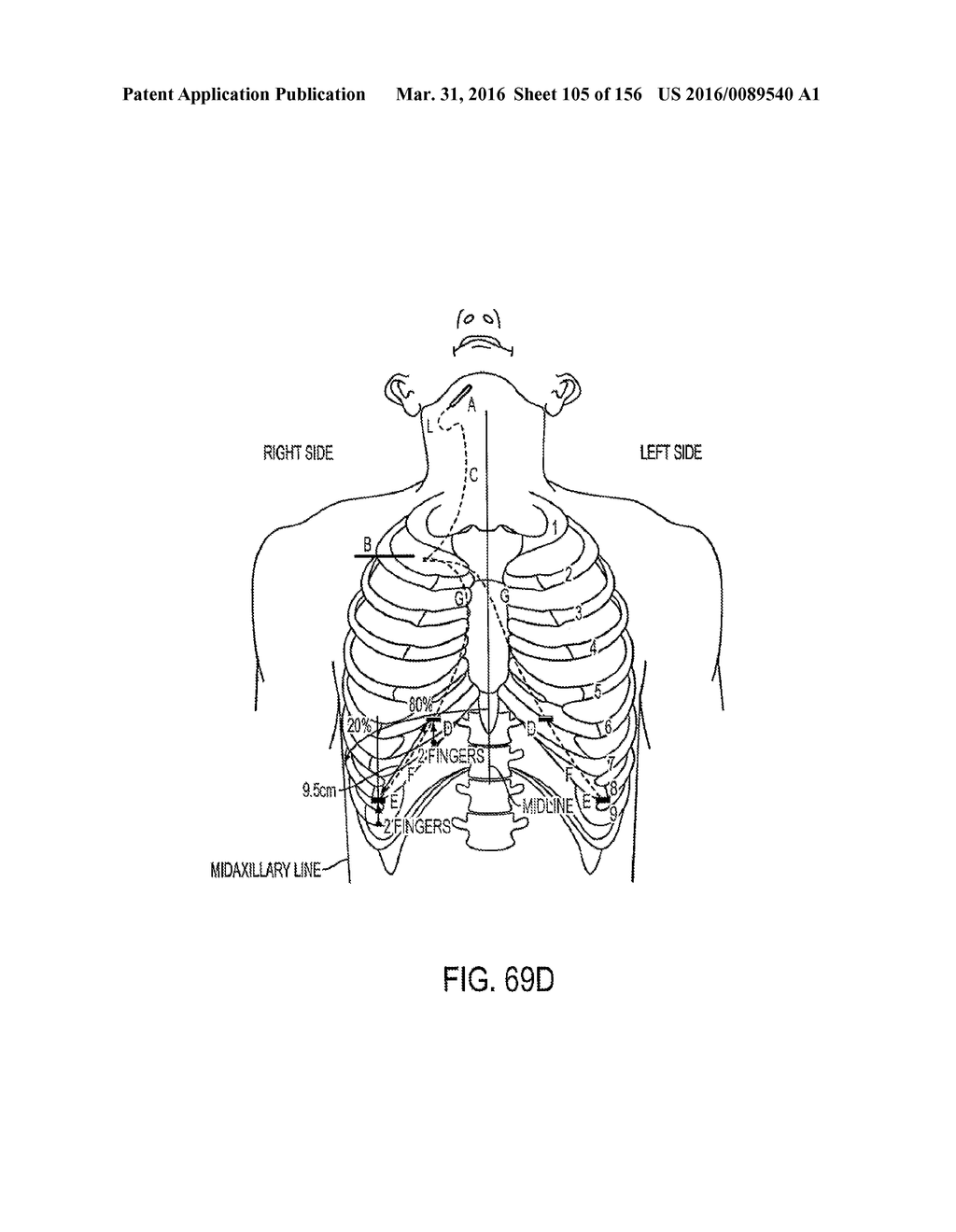 OBSTRUCTIVE SLEEP APNEA TREATMENT DEVICES, SYSTEMS AND METHODS - diagram, schematic, and image 106