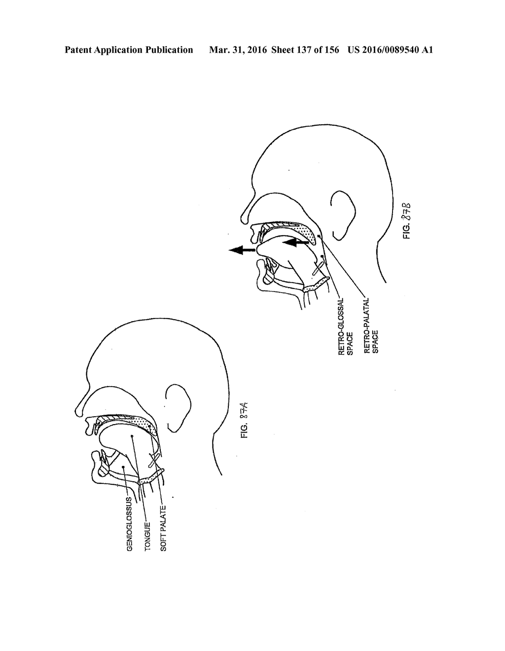 OBSTRUCTIVE SLEEP APNEA TREATMENT DEVICES, SYSTEMS AND METHODS - diagram, schematic, and image 138