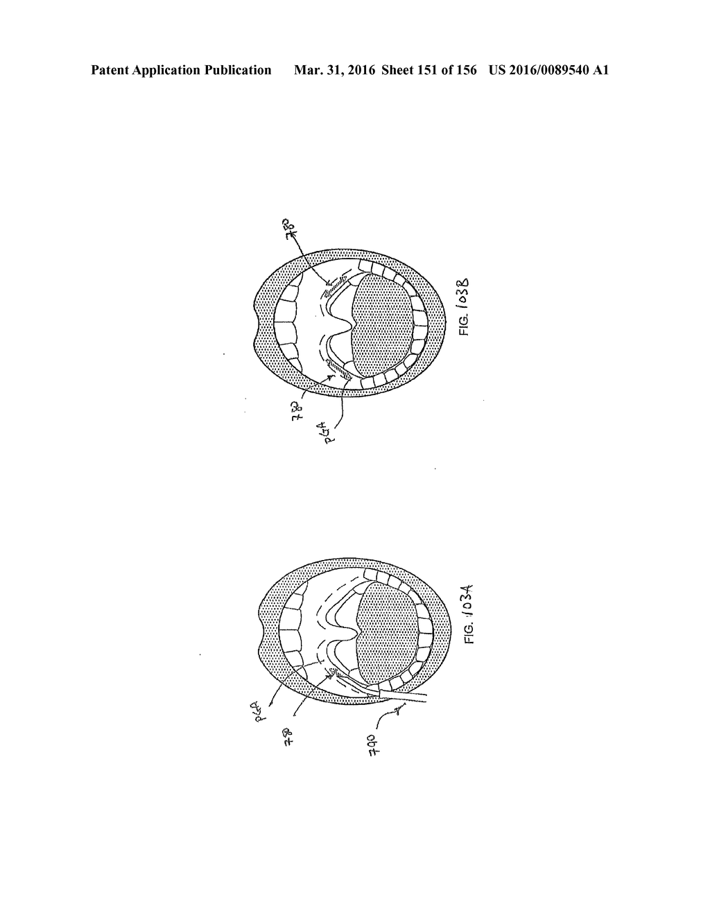 OBSTRUCTIVE SLEEP APNEA TREATMENT DEVICES, SYSTEMS AND METHODS - diagram, schematic, and image 152