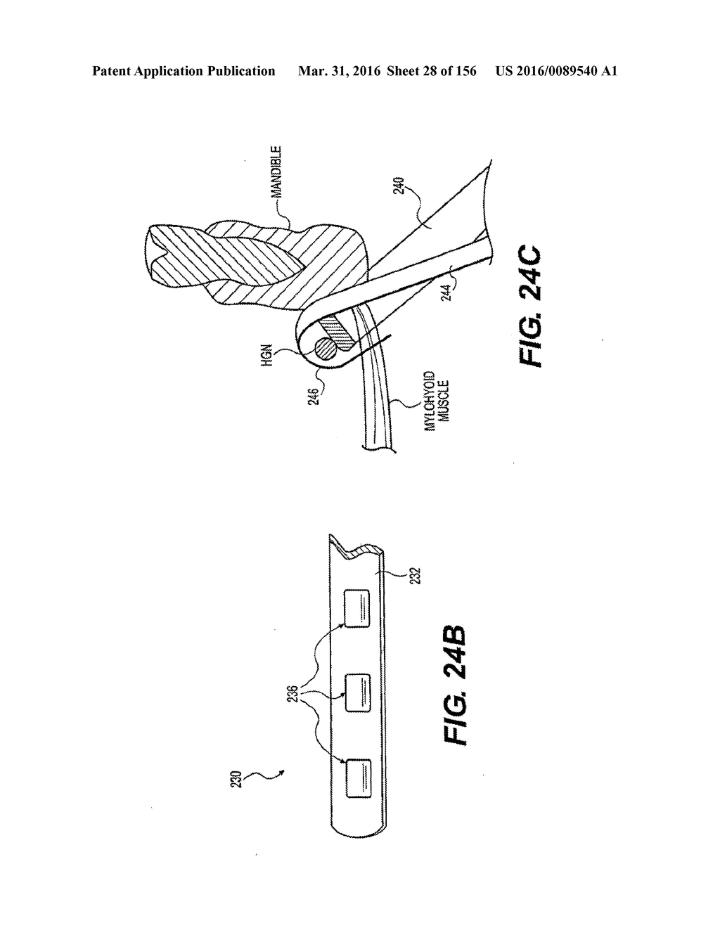 OBSTRUCTIVE SLEEP APNEA TREATMENT DEVICES, SYSTEMS AND METHODS - diagram, schematic, and image 29