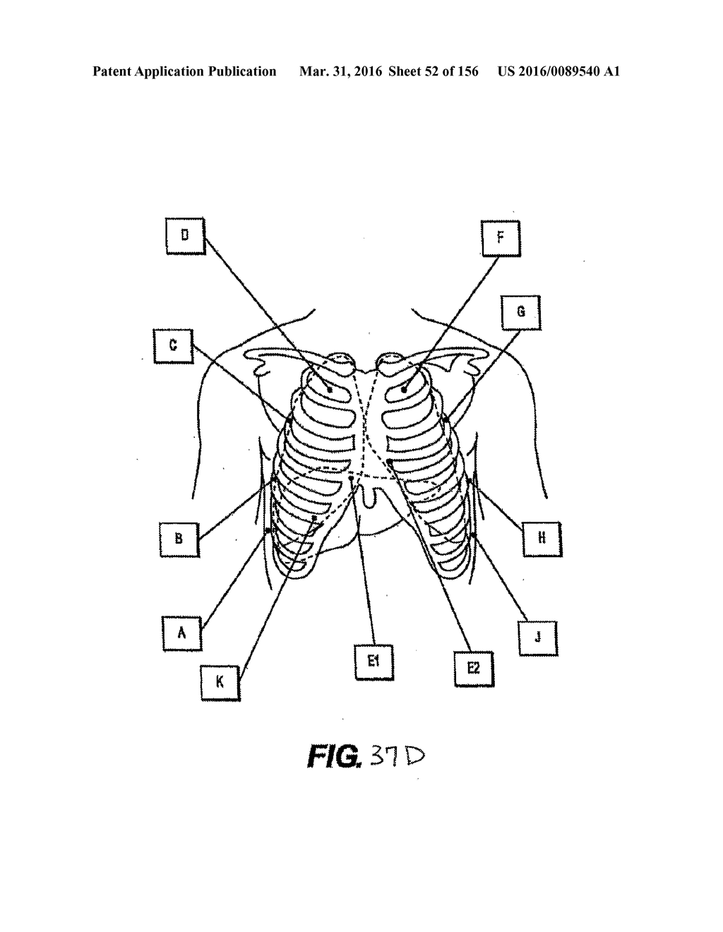 OBSTRUCTIVE SLEEP APNEA TREATMENT DEVICES, SYSTEMS AND METHODS - diagram, schematic, and image 53