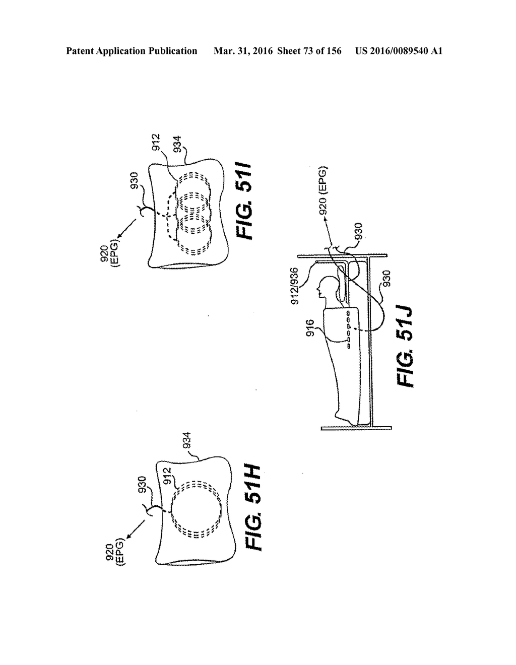 OBSTRUCTIVE SLEEP APNEA TREATMENT DEVICES, SYSTEMS AND METHODS - diagram, schematic, and image 74