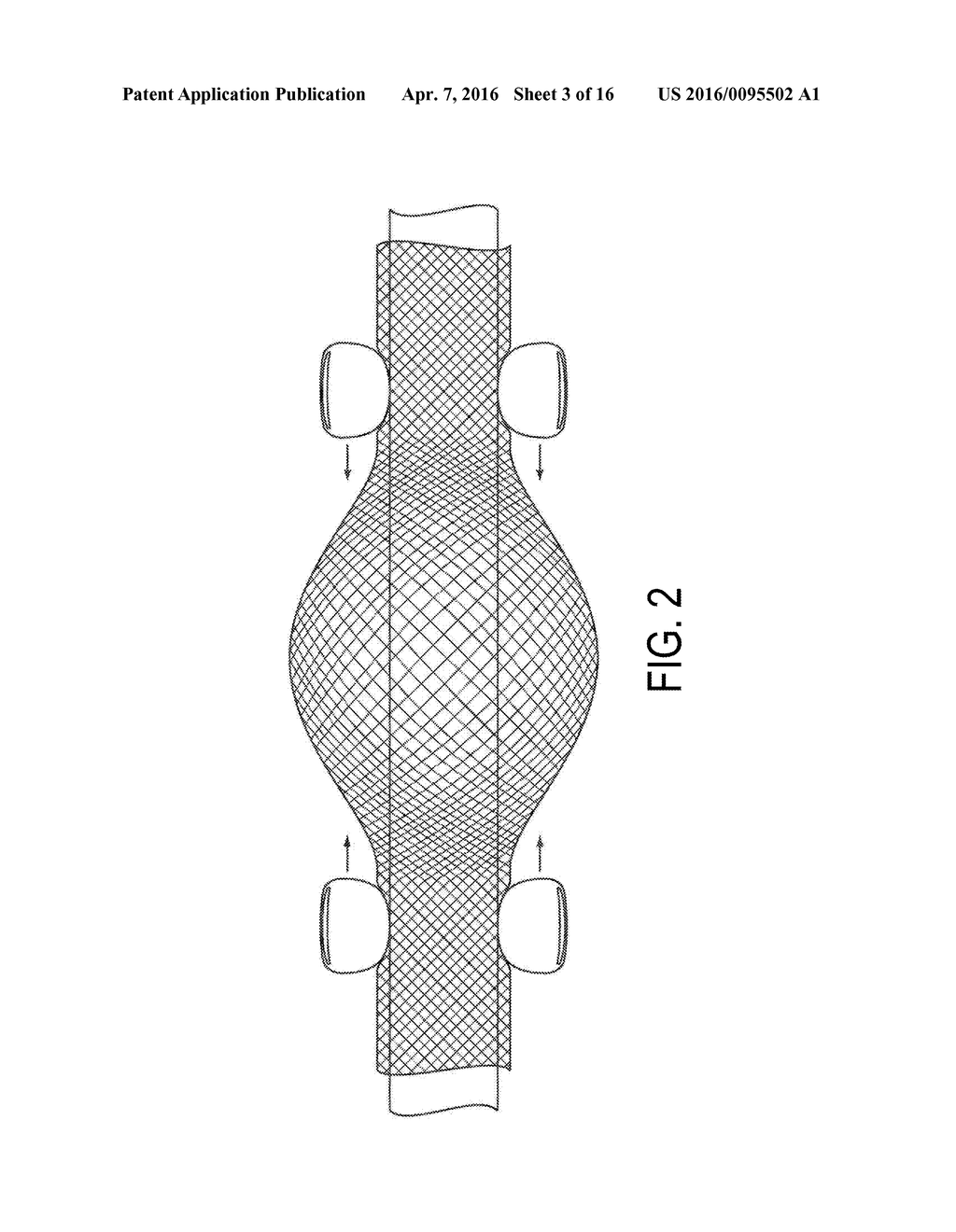 BRONCHOSCOPIC SHEATH FOR MEASURING OR SPACING - diagram, schematic, and image 04