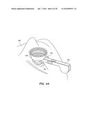 PATIENT INTERFACE FOR OPHTHALMOLOGIC DIAGNOSTIC AND INTERVENTIONAL     PROCEDURES diagram and image