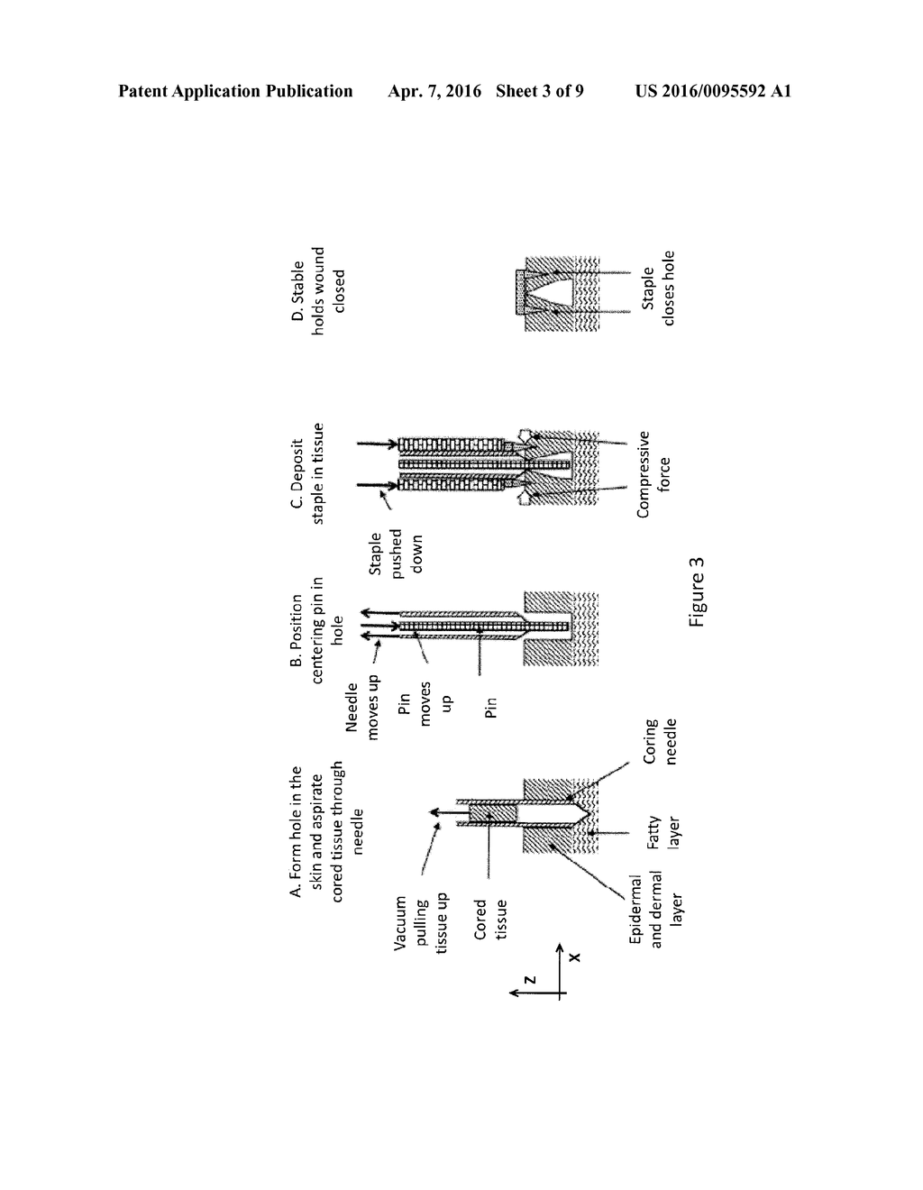 MICROCLOSURES AND RELATED METHODS FOR SKIN TREATMENT - diagram, schematic, and image 04