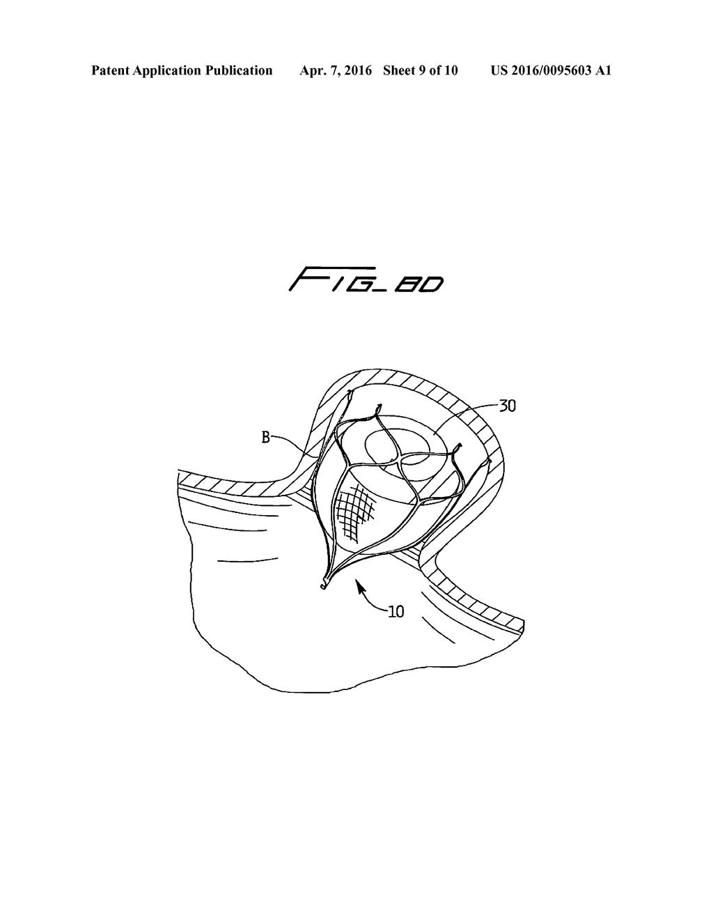 DEVICE FOR PREVENTING CLOT MIGRATON FROM LEFT ATRIAL APPENDAGE - diagram, schematic, and image 10