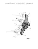 CLAMPING DEVICE FOR USE WITH AN ANATOMIC EXTERNAL FIXATION SYSTEM diagram and image