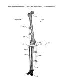 CLAMPING DEVICE FOR USE WITH AN ANATOMIC EXTERNAL FIXATION SYSTEM diagram and image