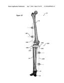 CLAMPING DEVICE FOR USE WITH AN ANATOMIC EXTERNAL FIXATION SYSTEM diagram and image