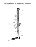 CLAMPING DEVICE FOR USE WITH AN ANATOMIC EXTERNAL FIXATION SYSTEM diagram and image