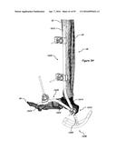 CLAMPING DEVICE FOR USE WITH AN ANATOMIC EXTERNAL FIXATION SYSTEM diagram and image