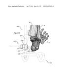 CLAMPING DEVICE FOR USE WITH AN ANATOMIC EXTERNAL FIXATION SYSTEM diagram and image