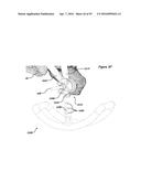 CLAMPING DEVICE FOR USE WITH AN ANATOMIC EXTERNAL FIXATION SYSTEM diagram and image