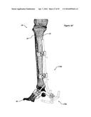 CLAMPING DEVICE FOR USE WITH AN ANATOMIC EXTERNAL FIXATION SYSTEM diagram and image