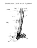 CLAMPING DEVICE FOR USE WITH AN ANATOMIC EXTERNAL FIXATION SYSTEM diagram and image