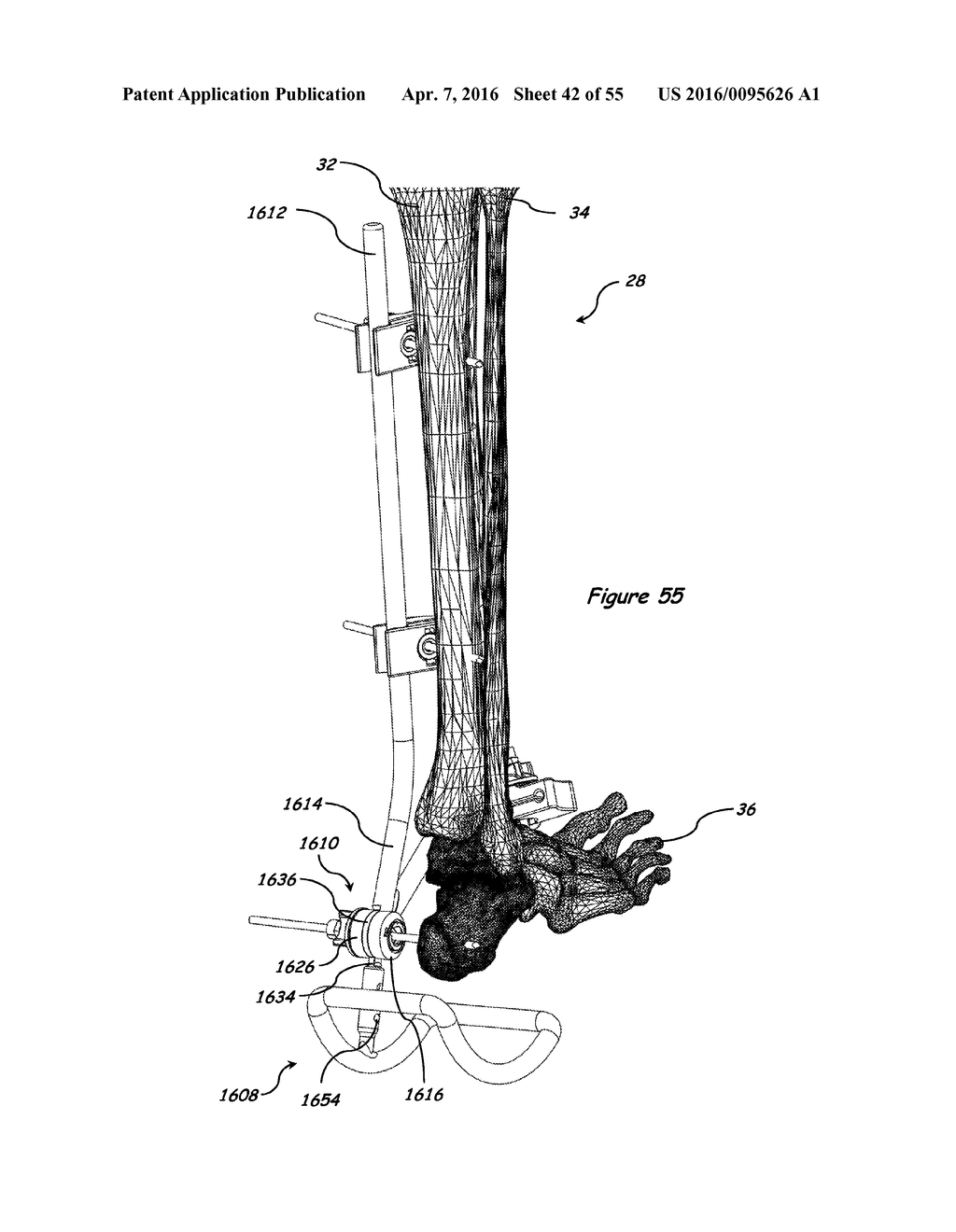 ANATOMIC EXTERNAL FIXATION SYSTEM FOR THE ANKLE - diagram, schematic, and image 43