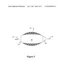 CEMENT-DIRECTING ORTHOPEDIC IMPLANTS diagram and image