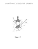 CEMENT-DIRECTING ORTHOPEDIC IMPLANTS diagram and image
