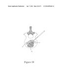 CEMENT-DIRECTING ORTHOPEDIC IMPLANTS diagram and image