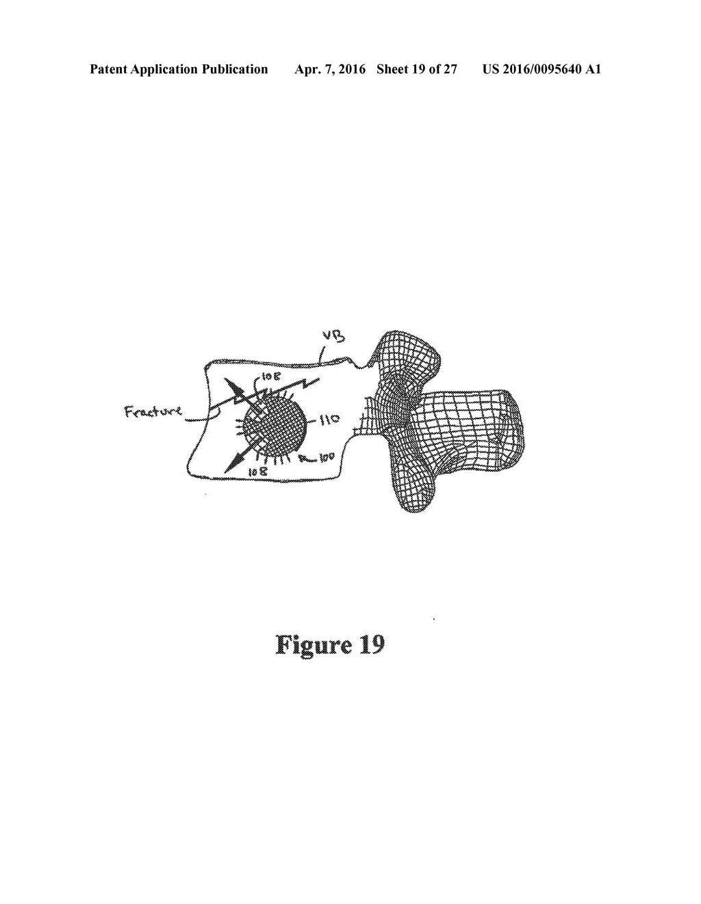 CEMENT-DIRECTING ORTHOPEDIC IMPLANTS - diagram, schematic, and image 20