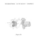 CEMENT-DIRECTING ORTHOPEDIC IMPLANTS diagram and image