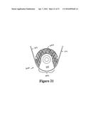 CEMENT-DIRECTING ORTHOPEDIC IMPLANTS diagram and image