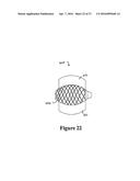 CEMENT-DIRECTING ORTHOPEDIC IMPLANTS diagram and image