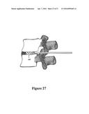 CEMENT-DIRECTING ORTHOPEDIC IMPLANTS diagram and image