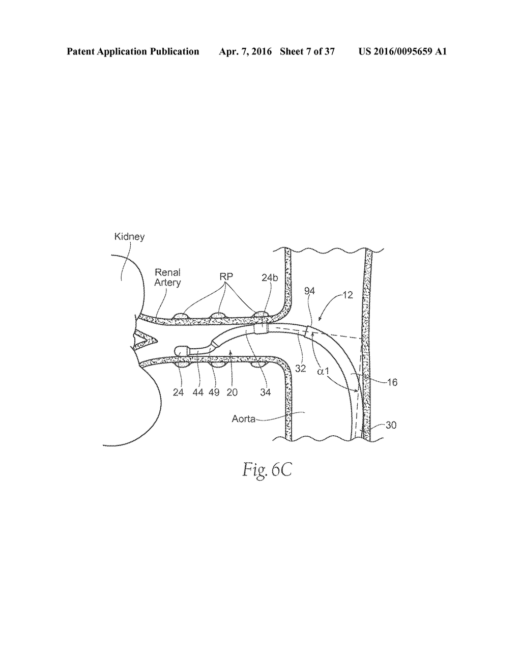 Catheter Apparatuses, Systems, and Methods for Renal Neuromodulation - diagram, schematic, and image 08