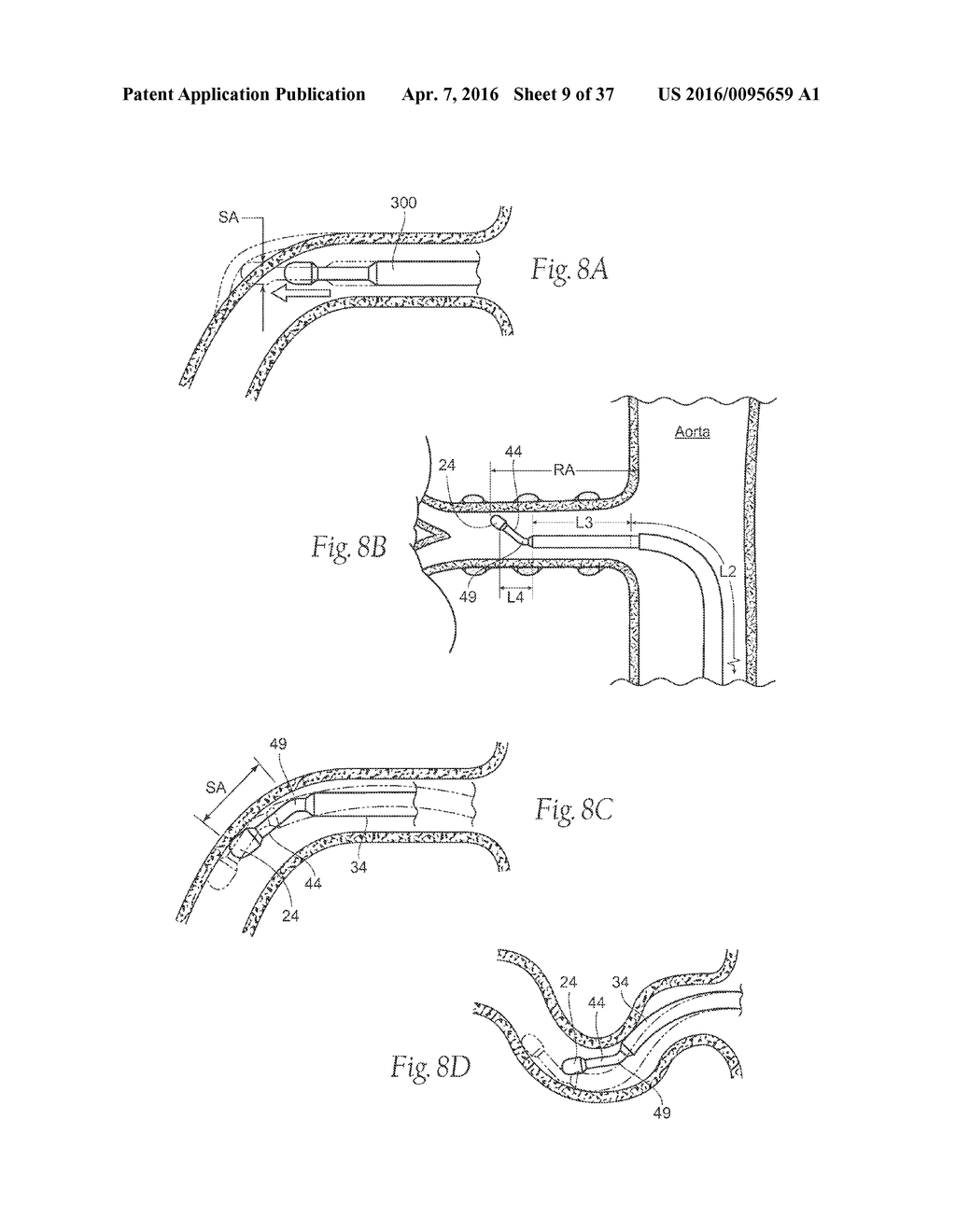 Catheter Apparatuses, Systems, and Methods for Renal Neuromodulation - diagram, schematic, and image 10