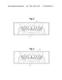 TOOTH ATTACHMENT PLACEMENT DEVICE diagram and image