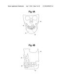 TOOTH ATTACHMENT PLACEMENT DEVICE diagram and image