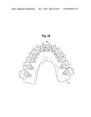 TOOTH ATTACHMENT PLACEMENT DEVICE diagram and image